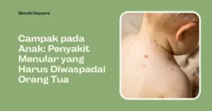 campak pada anak dimulti daycare